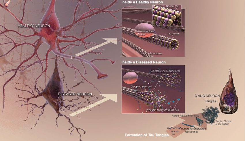 dying neuron due to neurofibrillary tangles