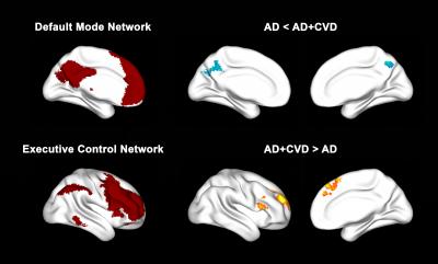 Il cervello mostra segni diversi se con l'Alzheimer c'è anche demenza vascolare 