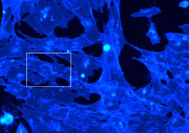 APOE4 astrocytes with altered lipid accumulation