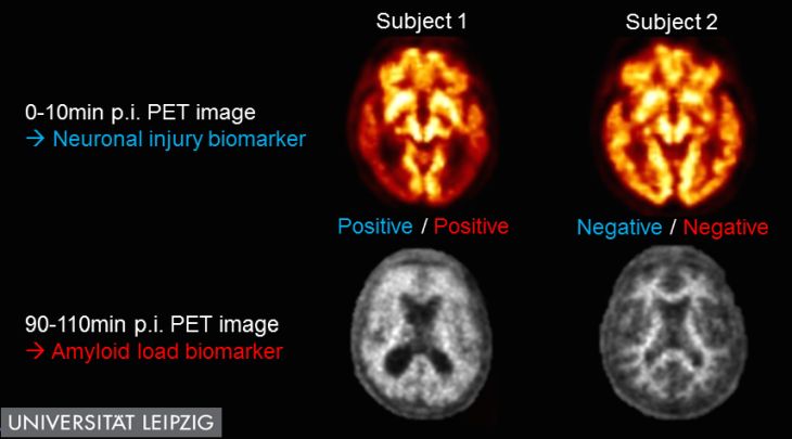 Una singola scansione PET a 2 tempi individua i marcatori dell'Alzheimer