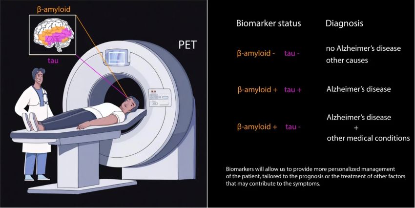 Biomarkers to diagnose alzheimer Karolinska