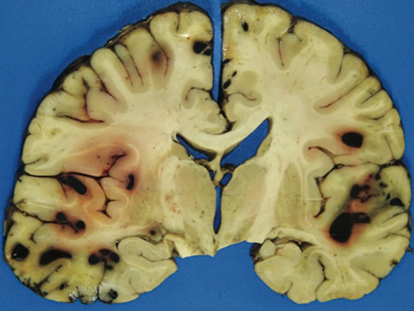 Brain Hemorrhages patient who received t PA and lecanemab