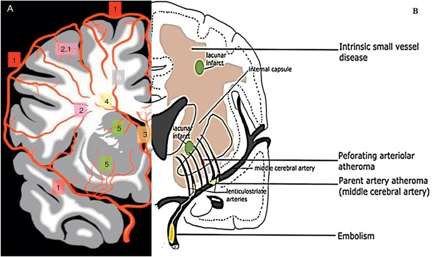Cerebral vasculature and vasculo pathological process of Cerebral Small Vessel Disease Mustapha et al