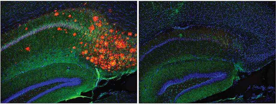 Depletion of cholesterol in astrocyte right removes plaques and tau left