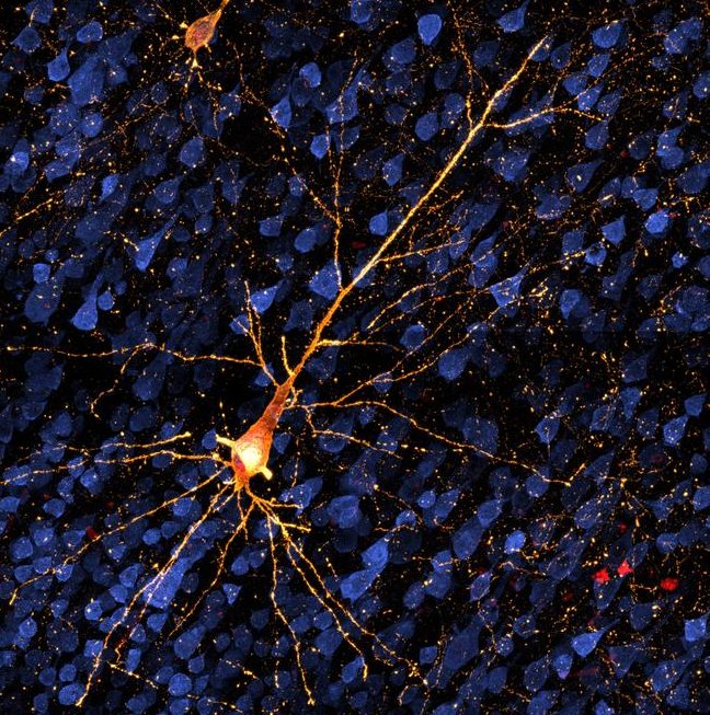 Dying neuron damaged by tau by Danielle Beckman UCDavis