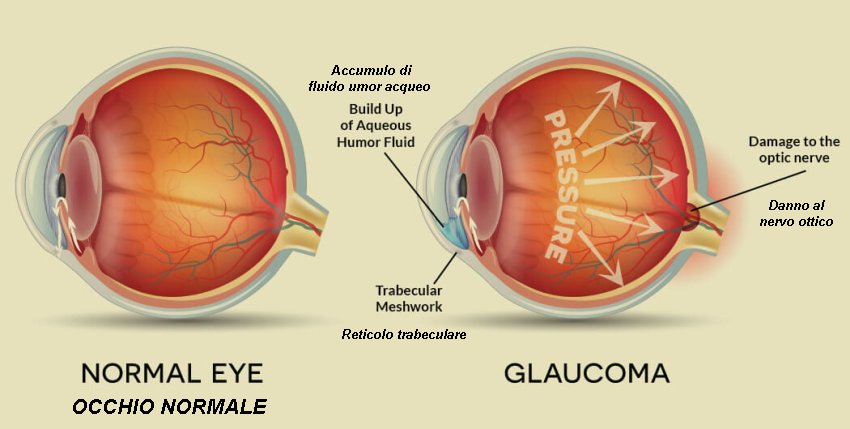 Eye with glaucoma with translation