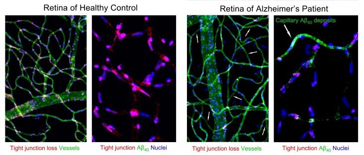 Healthy retina left and Alzheimer right