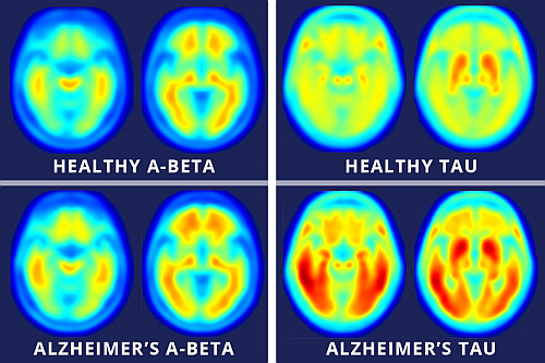 La scansione della Tau (invece dell'amiloide) come marcatore del progresso dell'Alzheimer