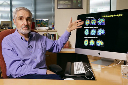 Le scansioni PET mostrano lo sviluppo dell'Alzheimer dal vivo