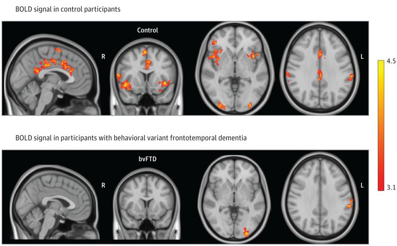 Lindberg et al JamaNetwOpen empathy in dementia