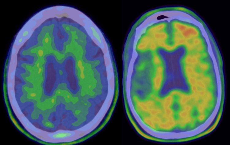 Trovata una promettente strategia di diagnosi precoce per l'Alzheimer