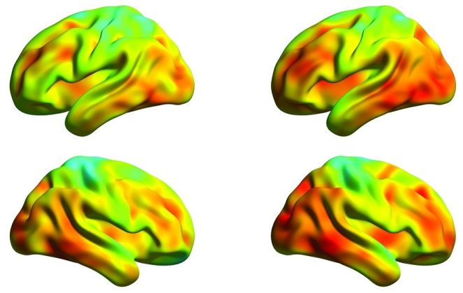 Misurata la diffusione della proteina tau nel cervello con Alzheimer