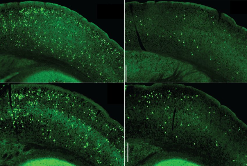 Tau aggregates diminished by depleting top right or inhibiting bottom right microglia NF kB