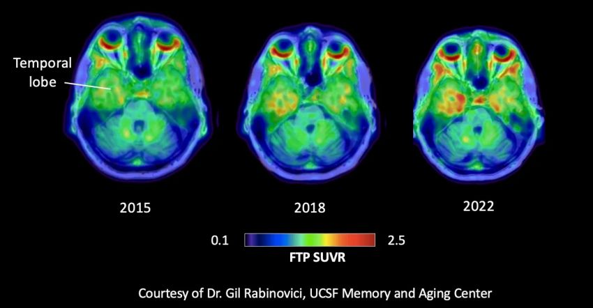 Temporal lobe tau scans over time for Dan Gibbs