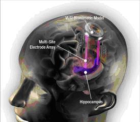 'Protesi cerebrale' punta a una svolta per chi soffre di perdita di memoria