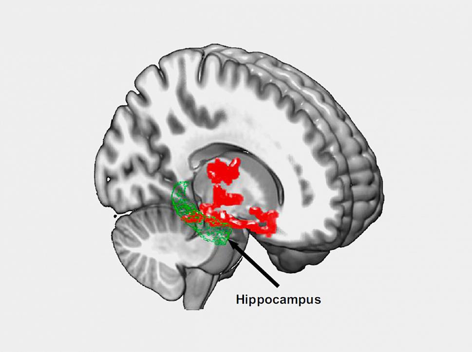 beta amyloid brain regions