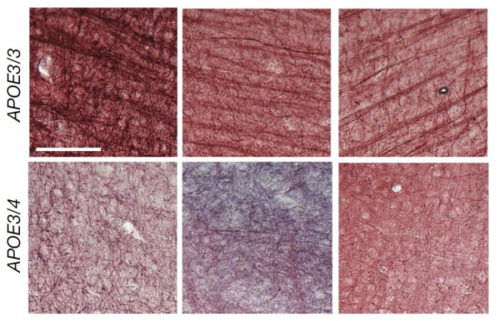 clear streaks of myelin in APOE3 carriers top and less with 1 copy of APOE4