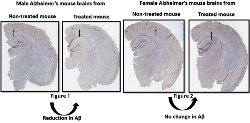 effects of sex specific difference of alzheimer