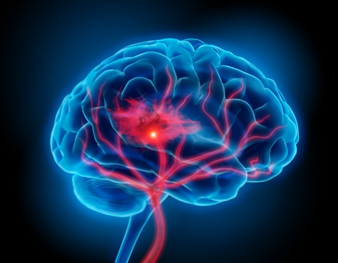 Le malattie cerebrovascolari collegate da uno studio all'Alzheimer