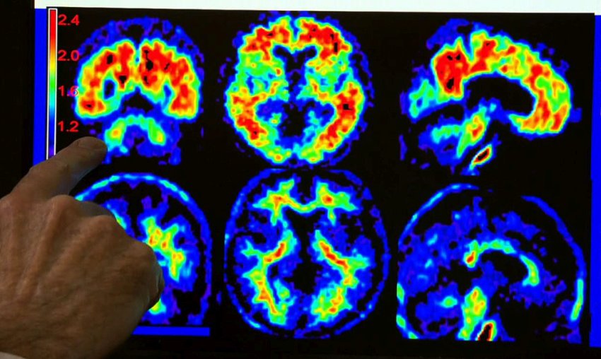 scans of brain with and without alzheimer