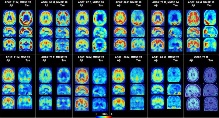 variety of tau and amyloid imaging 